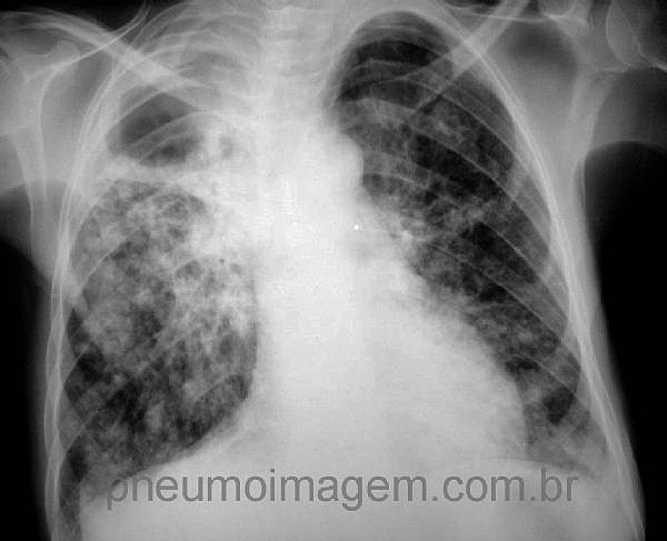 NOVAS DIRETRIZES PARA TUBERCULOSE DO NICE (2016): CLIQUE AQUI.
